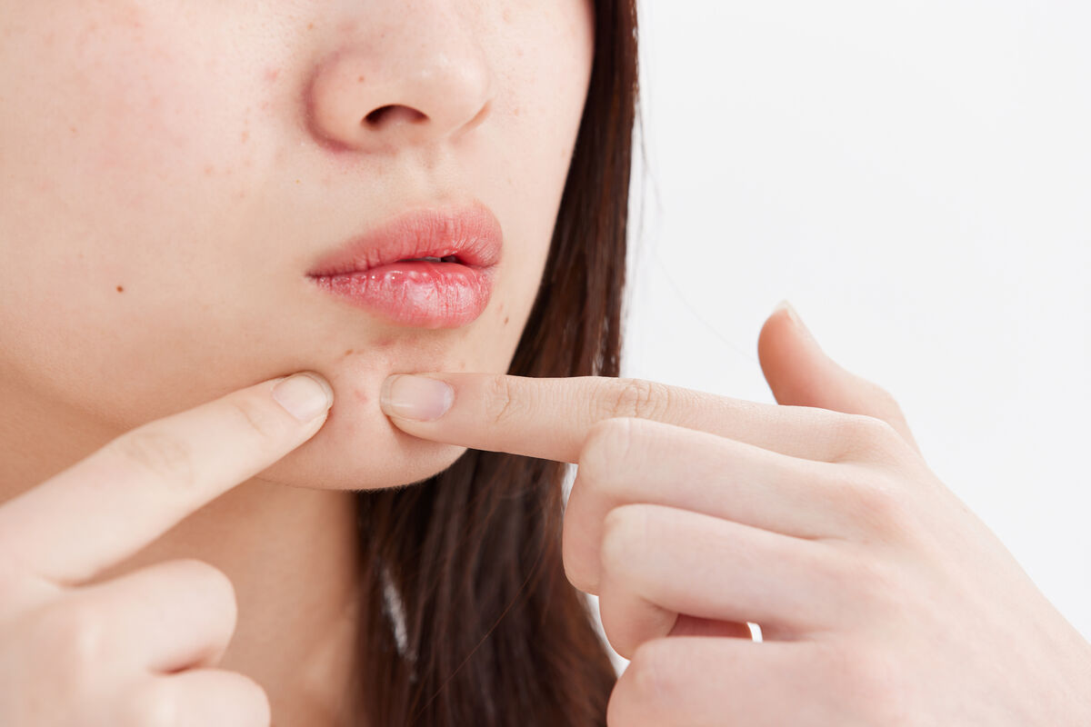 Close-up of active acne breakouts on the chin before a dermatology evaluation in Queens